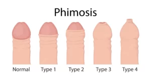 Phimosis - Cure Stone - Urology, Andrology, Renal Transplant